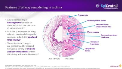Features of airway remodelling and the role of epithelial cytokines